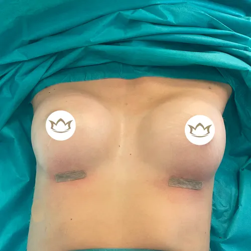 Befund direkt nach der Operation